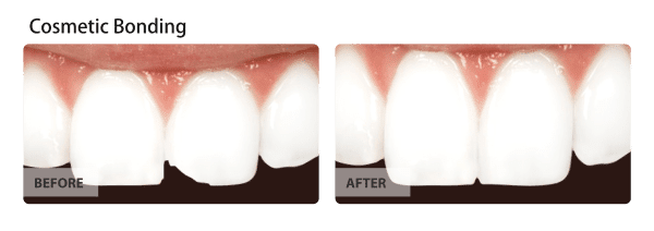 Before and after image of Cosmetic-bonding