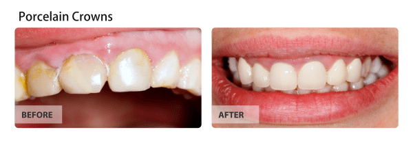 Before and after image of Porcelain-crowns