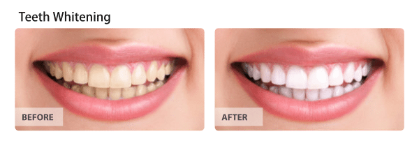 Teeth-whitening-1-1