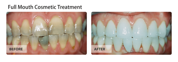Before and after image of full-mouth-cosmetic
